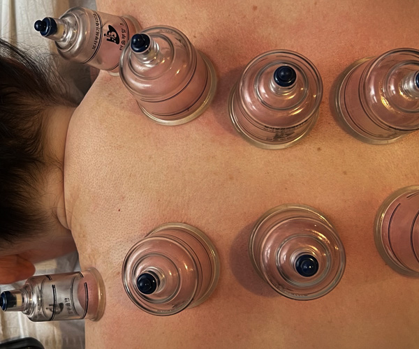 Myofascial Cupping | Norton Sports Massage Therapy